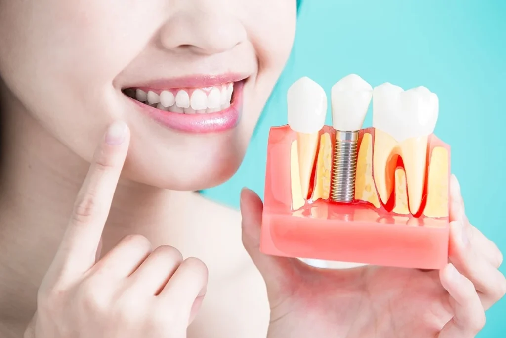 چند نوع ایمپلنت دندان داریم و بهترین نوع ایمپلنت کدام است