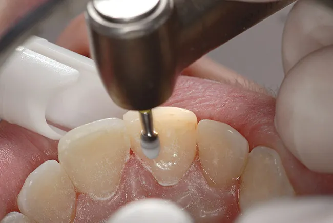 آیا کامپوزیت دندان قابل برداشتن است؛ نحوه انجام و دلایل