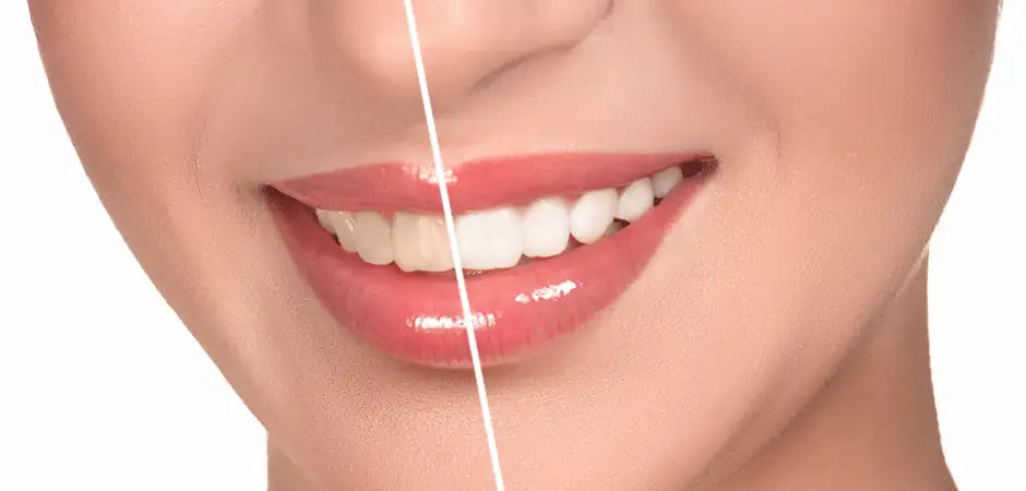 برای سفید شدن کامپوزیت دندان چه کنیم؛ انواع روش ها