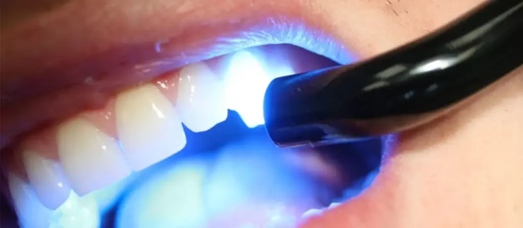 کامپوزیت دندان چگونه انجام می شود