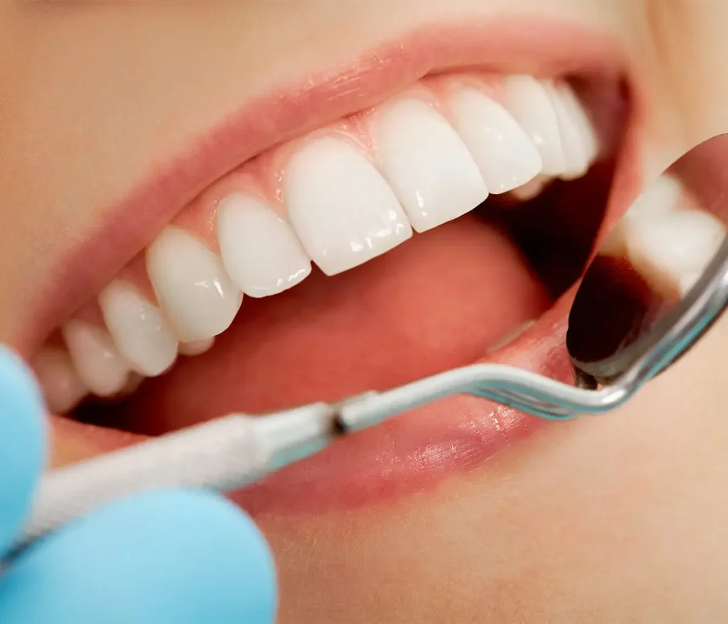 کامپوزیت برای چه دندان هایی مناسب است؟ (برسی کامل)